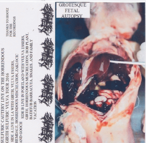 Sulfuric Cautery : Grotesque Fetal Autopsy